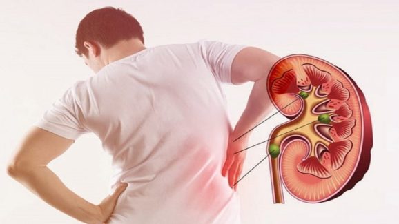 Early Symptoms of Kidney Stone Formation: Here are Prevention Tips