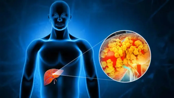 Hidden Dangers on Your Plate: How Daily Diet Choices Can Increase Liver Cancer Risk