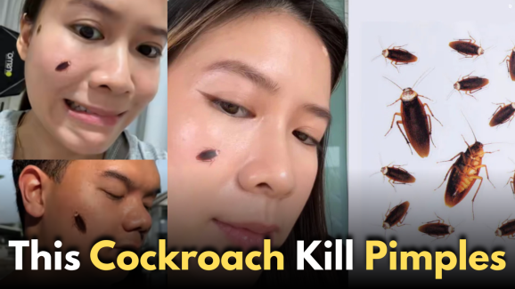This Cockroach Kill Pimples: Weird Pimple Patch goes viral