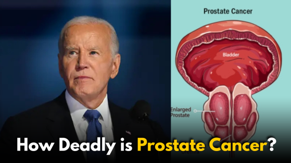 Prostate Cancer Explained Amid Biden’s Health Update