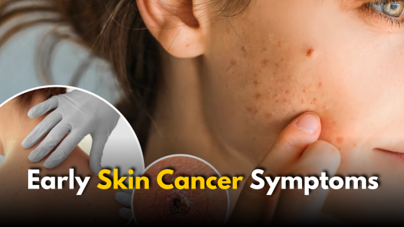 Early Skin Cancer Symptoms: Harvard Expert Issues Warning