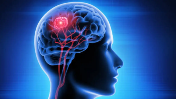 Brain Tumor Early Symptoms: Do Not Ignore These Warning Signs