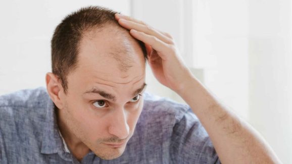 Regrow Hair on Blad Patches with These 5 Chinese Herbs