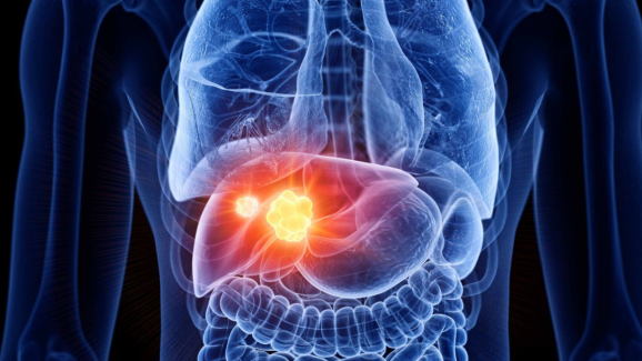 Liver Tumor: 10 Warning Signs You Shouldn’t Ignore