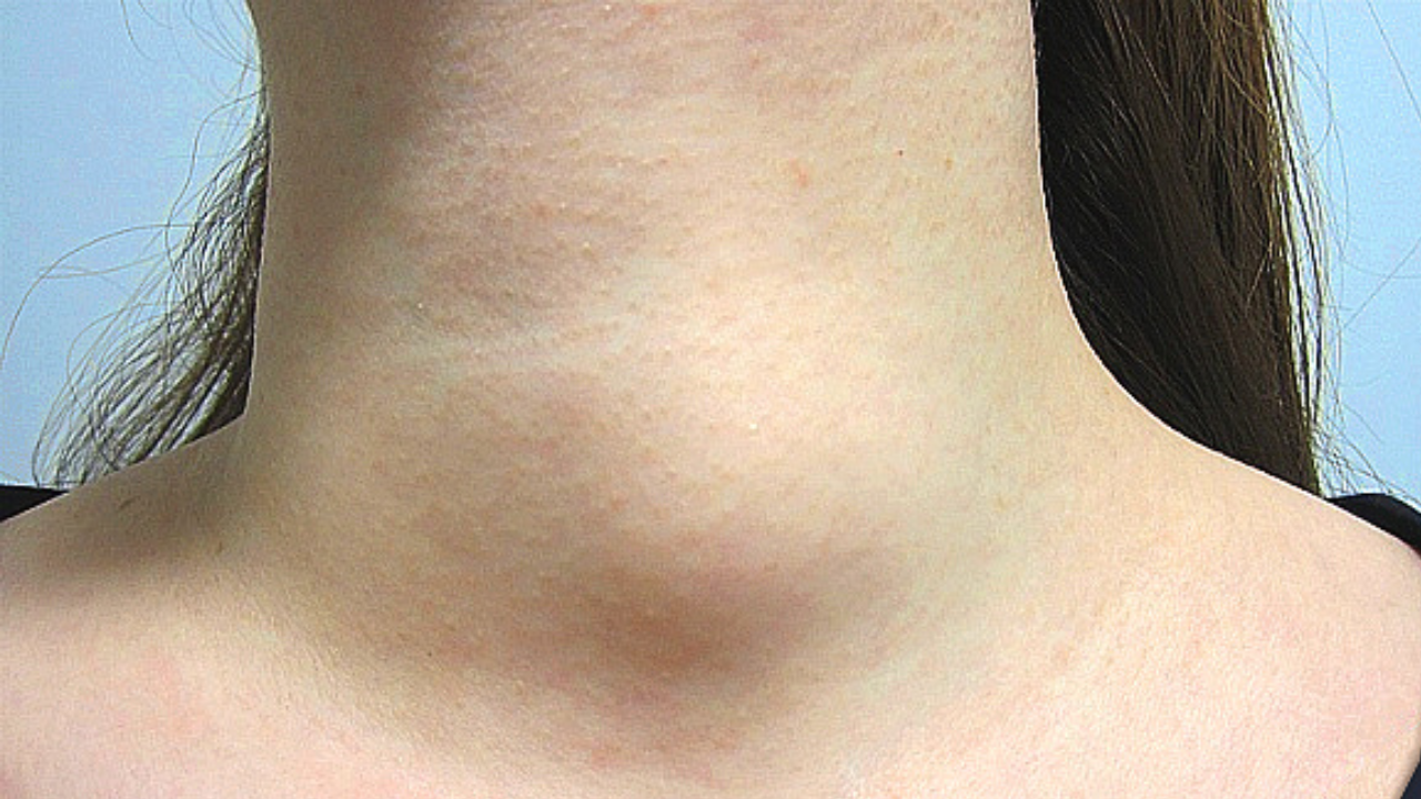 Thyroid Cancer: 5 Silent Symptoms You Shouldn’t Ignore