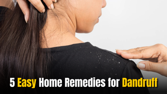 5 Easy Home Remedies for Dandruff from Your Kitchen