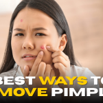Clear Skin at Home: Best Ways to Remove Pimples
