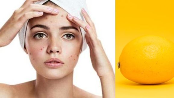 Lemon Bleach For Face: How to Safely Brighten Your Skin at Home