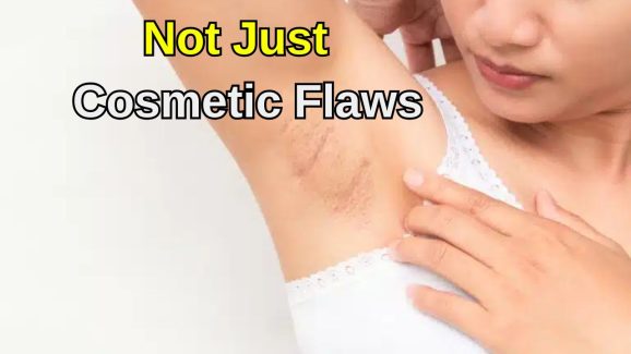 Why Dark Underarms Might Mean Health Trouble Not Just A Skin Issue