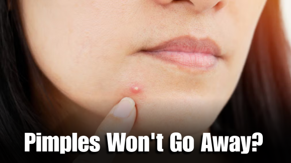 Pimples That Won’t Go Away : 5 Signs of Skin Cancer