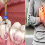 Can A Root Canal Cause Heart Attack? Here’s The Truth