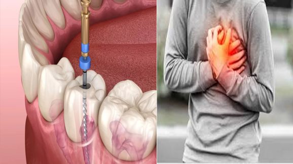 Can A Root Canal Cause Heart Attack? Here’s The Truth