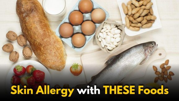Everyday Foods That May Trigger Skin Allergies