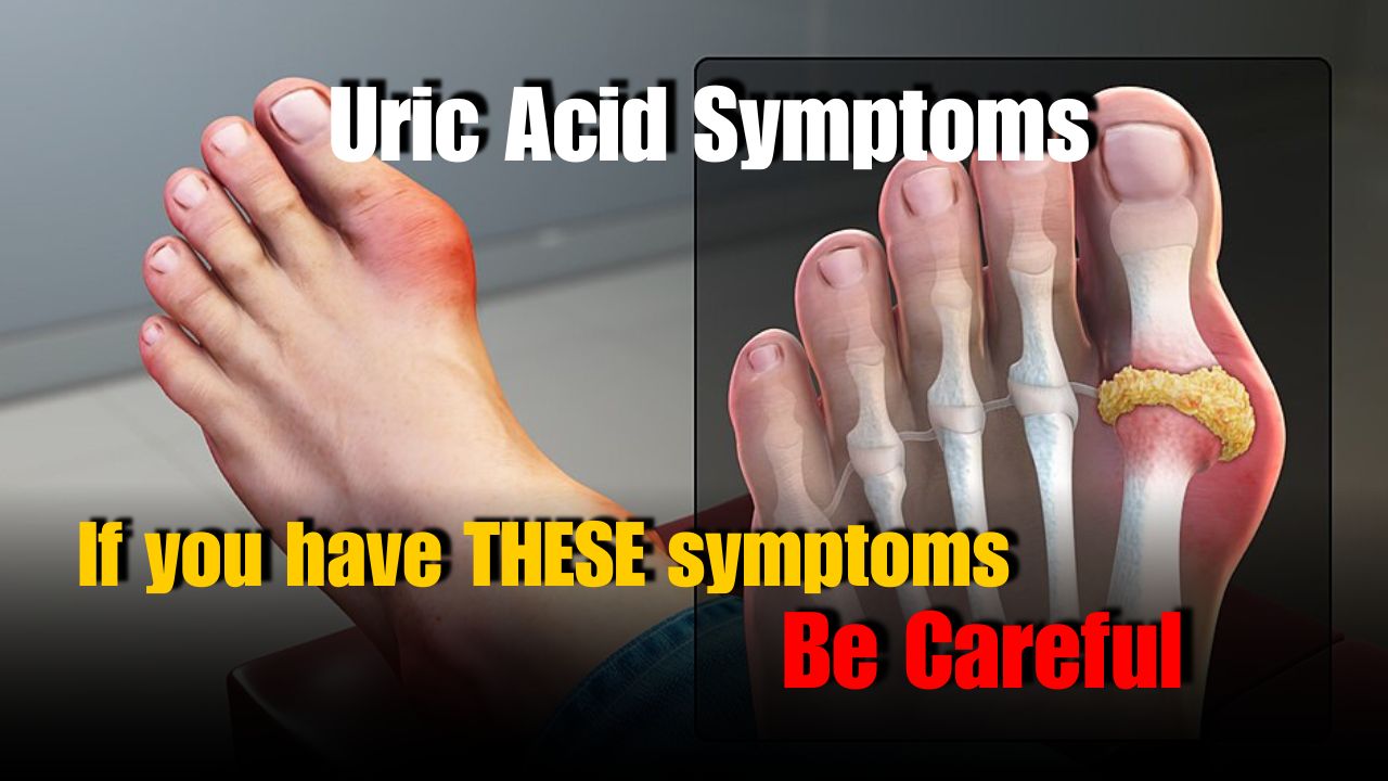 Uric Acid Symptoms: Signs Your Body Has High Levels