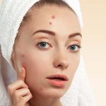 Gut and Hormone Remedies for Acne For proper skincare