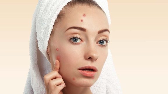Gut and Hormone Remedies for Acne For proper skincare