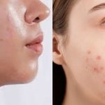 Foods That Can Worsen Your Oily Skin And Cause Acne