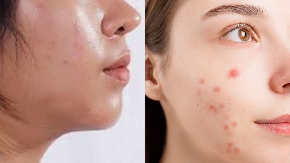 Foods That Can Worsen Your Oily Skin And Cause Acne