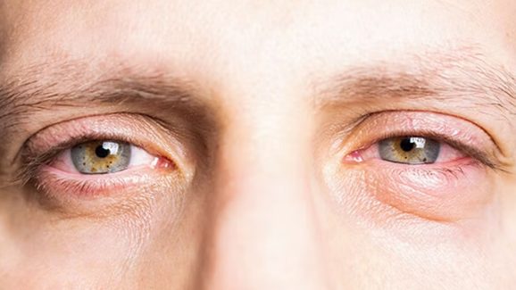 Sleep Deprivation Is Silently Destroying Your Eyesight – Here’s Why