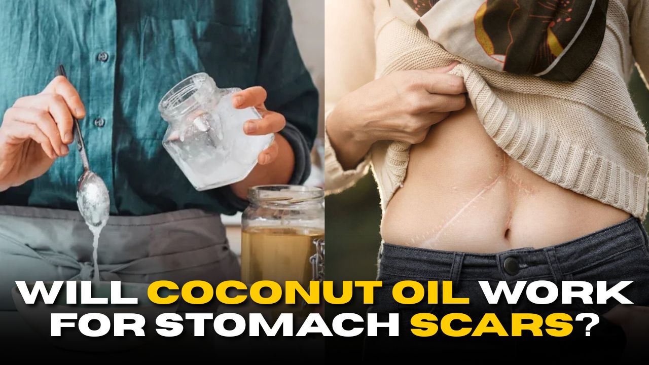 Coconut Oil for Stomach Scars: Myth or Miracle?