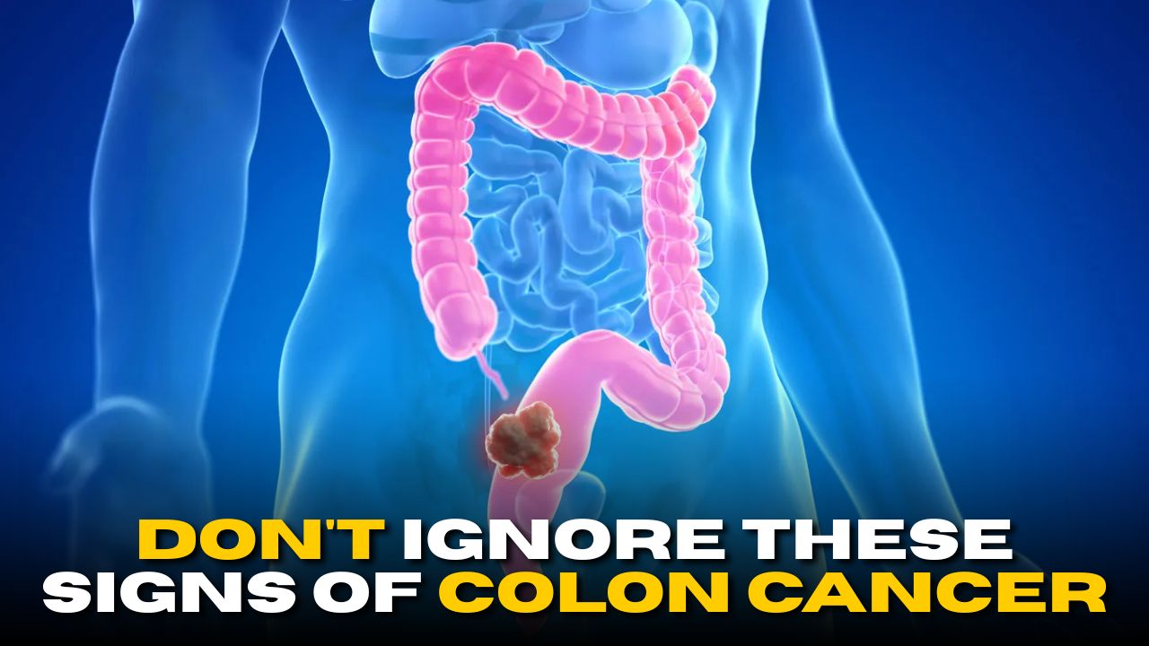 Don’t Ignore These Signs of Colon Cancer