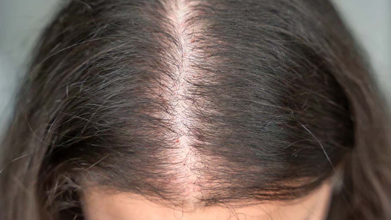 Say Goodbye To Hair Thinning With These Simple Remedies
