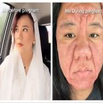 Shocking: Pregnancy Rash Goes Viral, Woman Shows Severe Skin Allergies