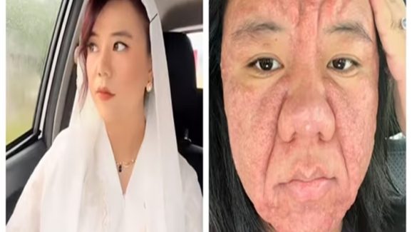 Shocking: Pregnancy Rash Goes Viral, Woman Shows Severe Skin Allergies