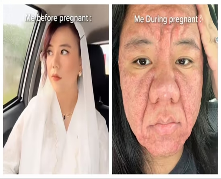 Shocking: Pregnancy Rash Goes Viral, Woman Shows Severe Skin Allergies