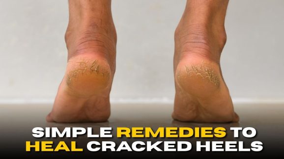Simple Remedies to Heal Cracked Heels Fast