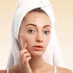 Pimples vs Acne: Is There a Difference?
