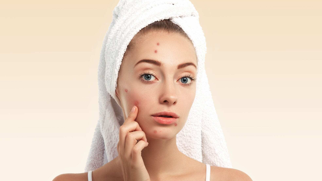 Pimples vs Acne: Is There a Difference?