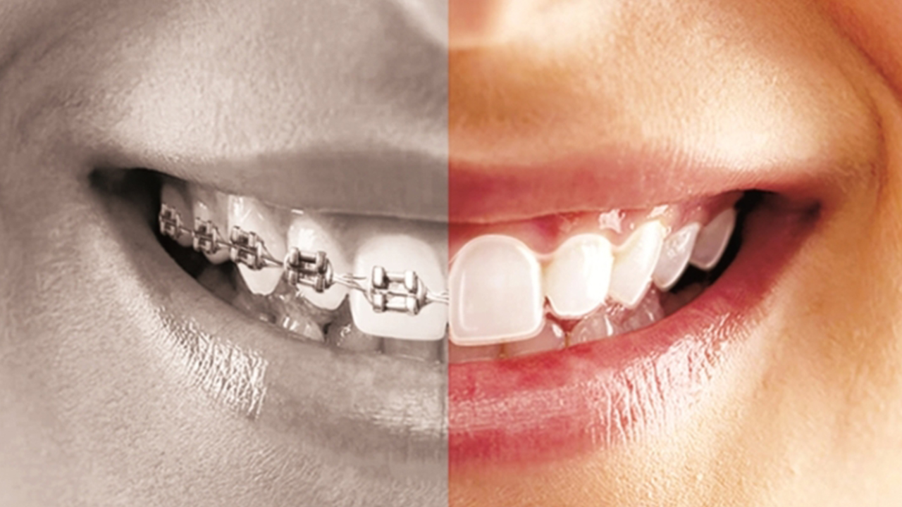 Braces Vs Aligners: What Is Better for Ideal Teeth?
