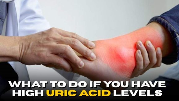 What to Do If You Have High Uric Acid Levels