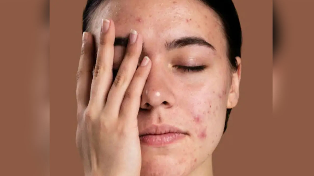 Tired of Dark Spots? Try This Easy Kitchen Remedy For Glowing Skin