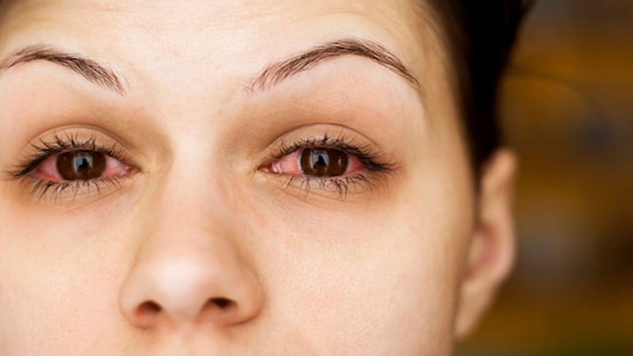 Eye Infections During Monsoon: Warning Signs You Shouldn’t Ignore