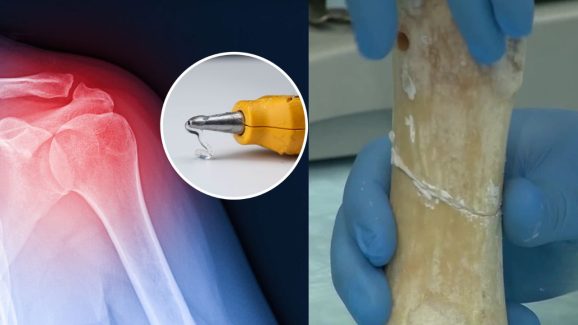 Broken Bone? Just paste it back in 3 Minutes: Here’s How