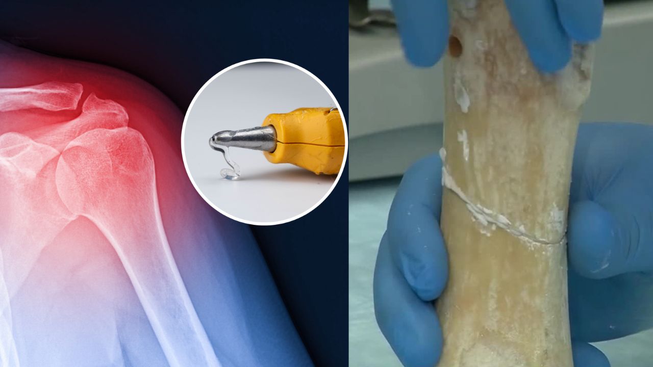 Broken Bone? Just paste it back in 3 Minutes: Here’s How