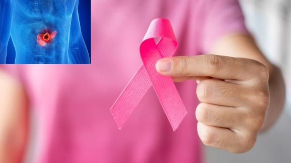 Fight Cancer Naturally With These Dairy Foods