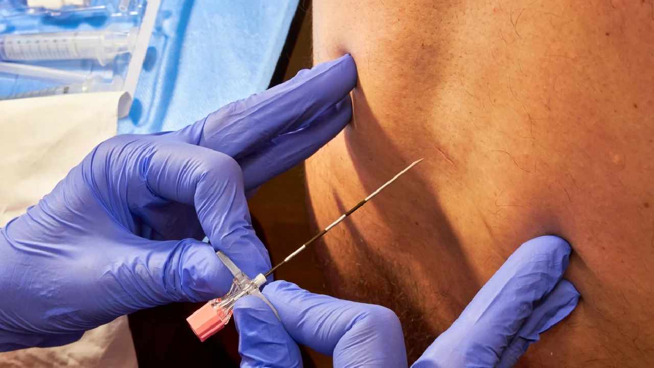 Epidural for Labour Pain: Safe Option or Risky Choice?