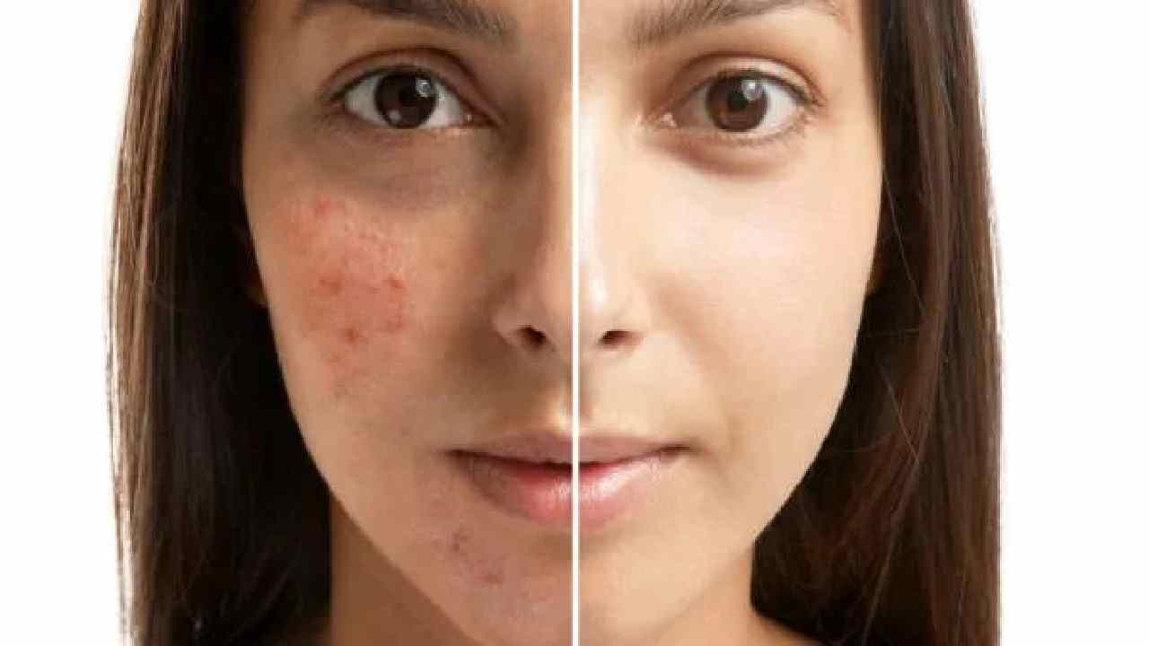 Top 5 Natural Ways to Clear Pimples and Glow Your Face