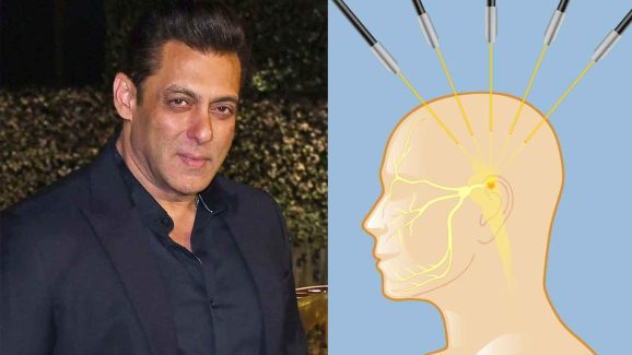 What is Trigeminal Neuralgia? Salman Khan’s Painful Disease Explained