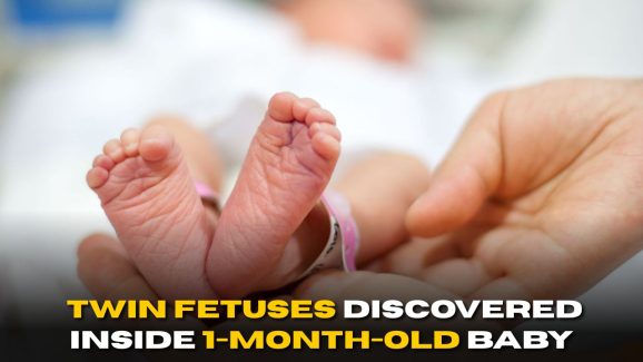 SHOCKING: Twin Fetuses Discovered Inside 1-Month-Old Baby’s Belly