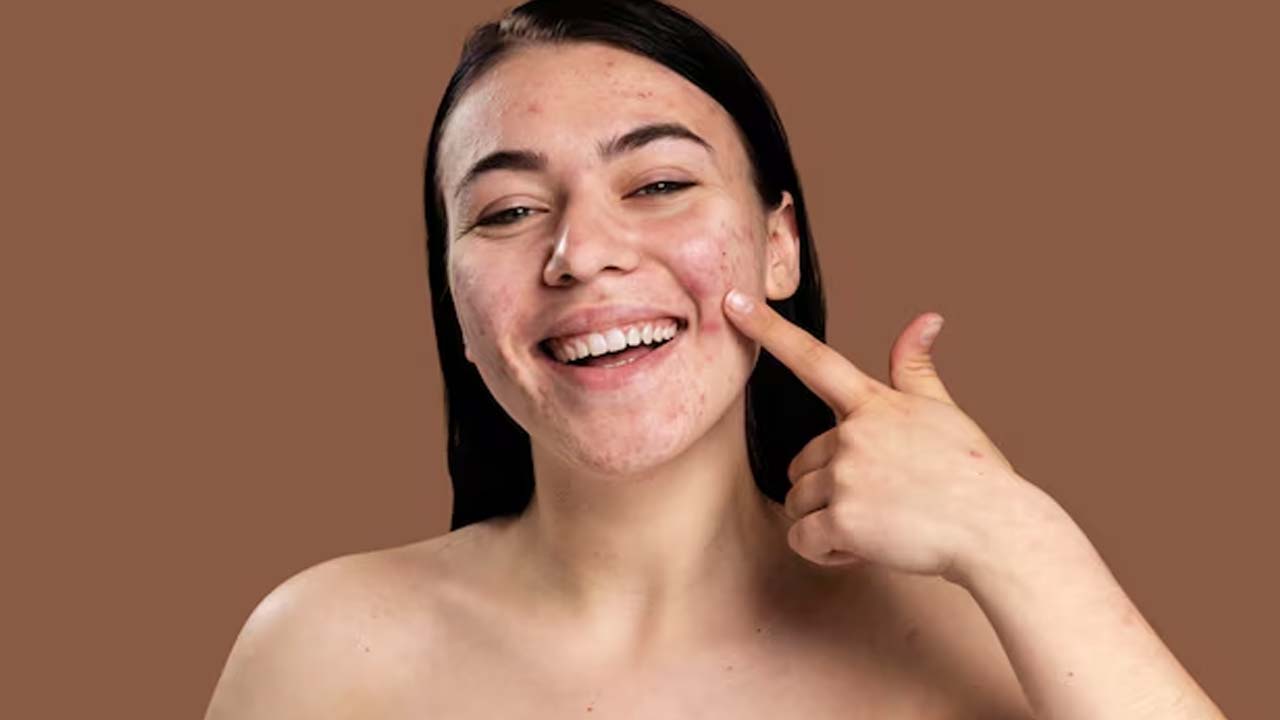 Fungal Acne in Humid Weather? Try This Dermatologist-Approved Routine