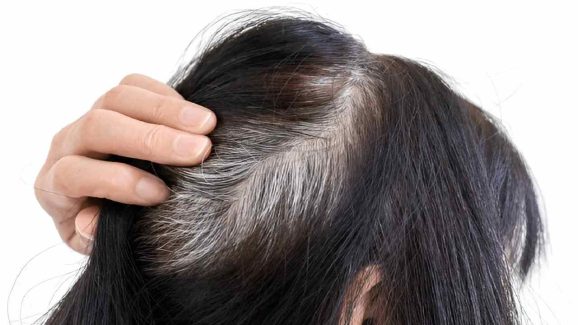 Natural Remedies to Prevent Early Graying of Hair