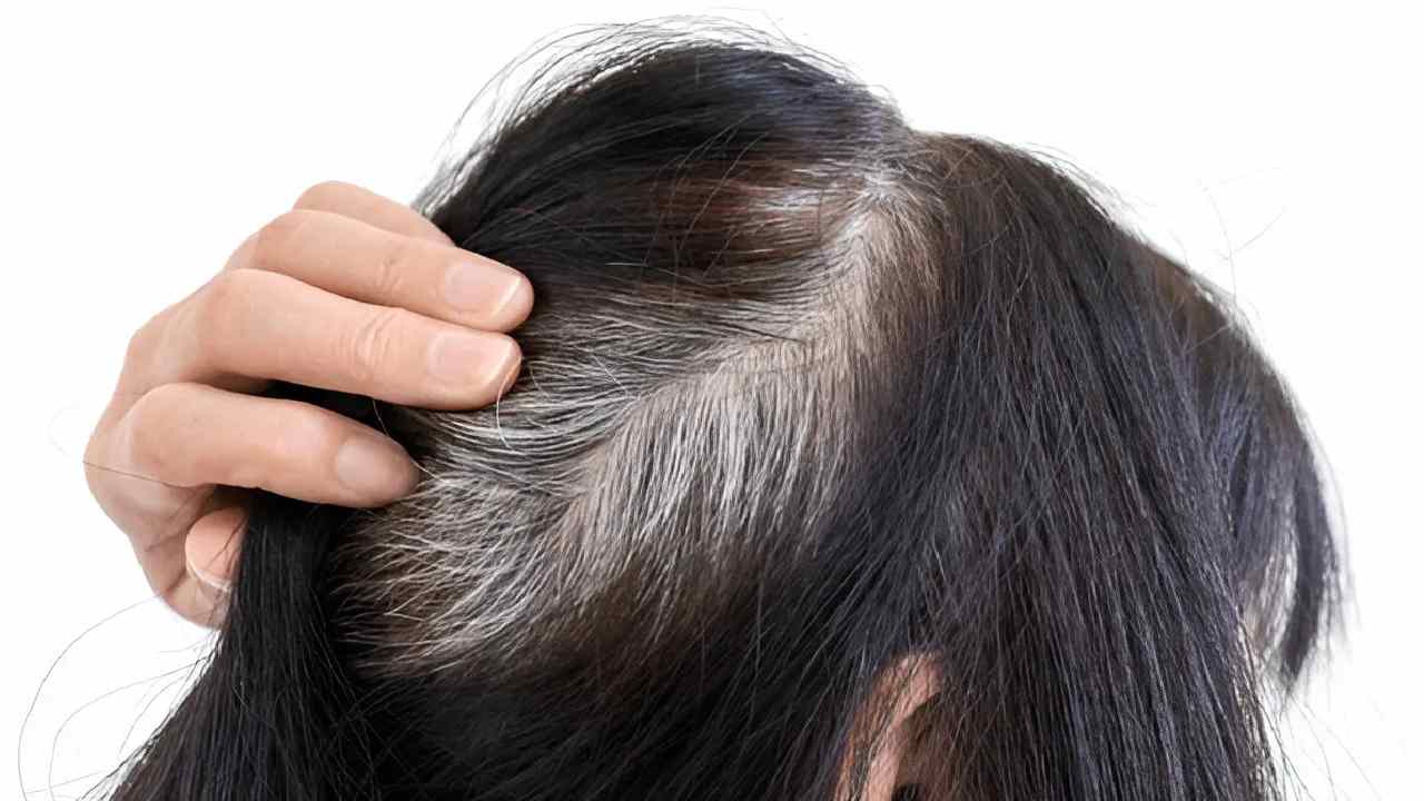 Natural Remedies to Prevent Early Graying of Hair