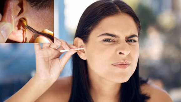 Easy Home Remedies to Melt and Remove Stubborn Earwax in Minutes