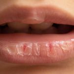 Chapped Lips in Winter: Know Why It Happens and How to Prevent It