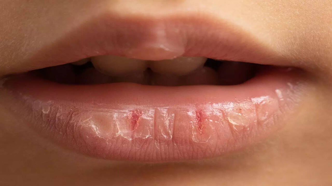 Chapped Lips in Winter: Know Why It Happens and How to Prevent It