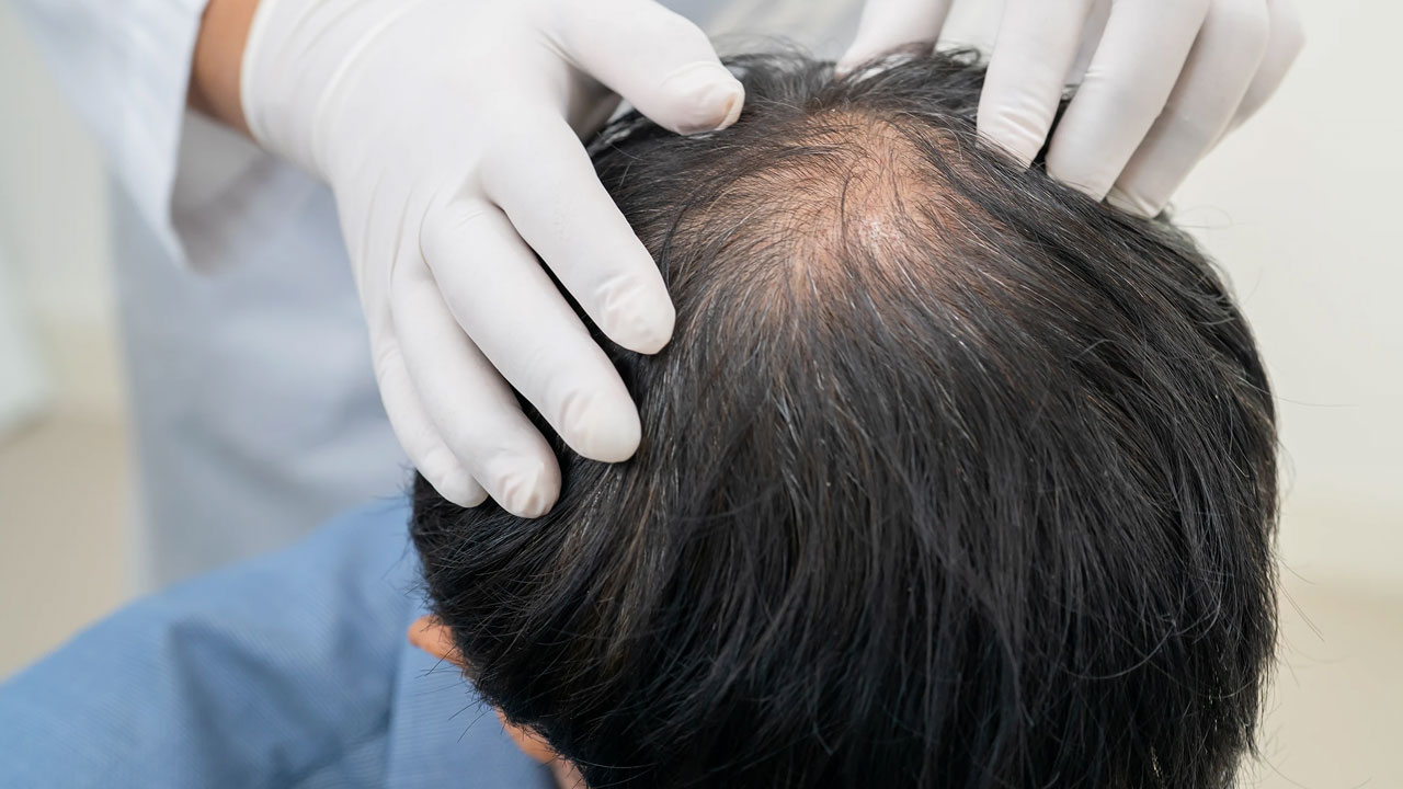Male Pattern Baldness: Early Signs, Causes and Simple Treatments